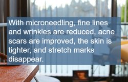 microneedling, dermapen, Dr. Dhai Barr's treatment room overlooking the Willamette River