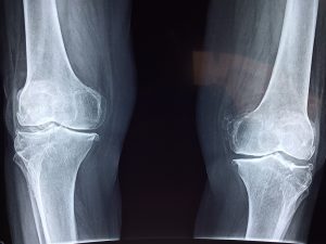 Knee x-ray illustrating knee cartilage growth after autologous adipose stem cell injection