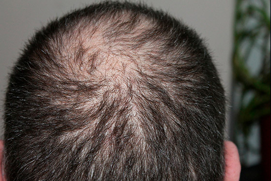 Hair Loss PRP therapy