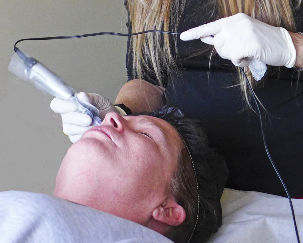 collagen induction therapy with microneedling and PRP