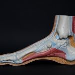 achilles tendonopathy