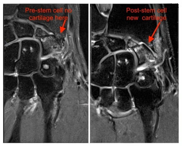 xrays of pre and post wrist stem cell injections