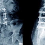 surgery vs. stem cell injection in lumbar spine