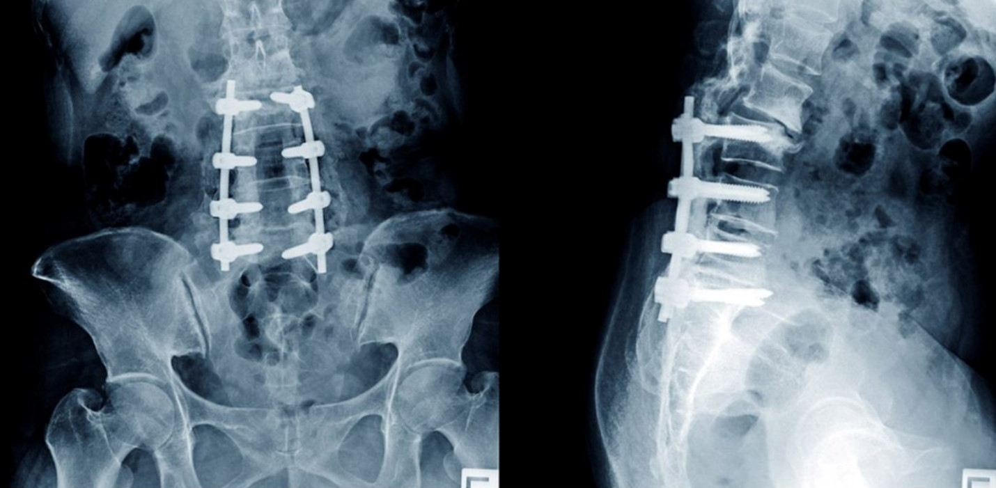 surgery vs. stem cell injection in lumbar spine