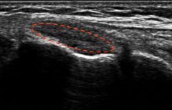 ultrasound image of torn meniscus