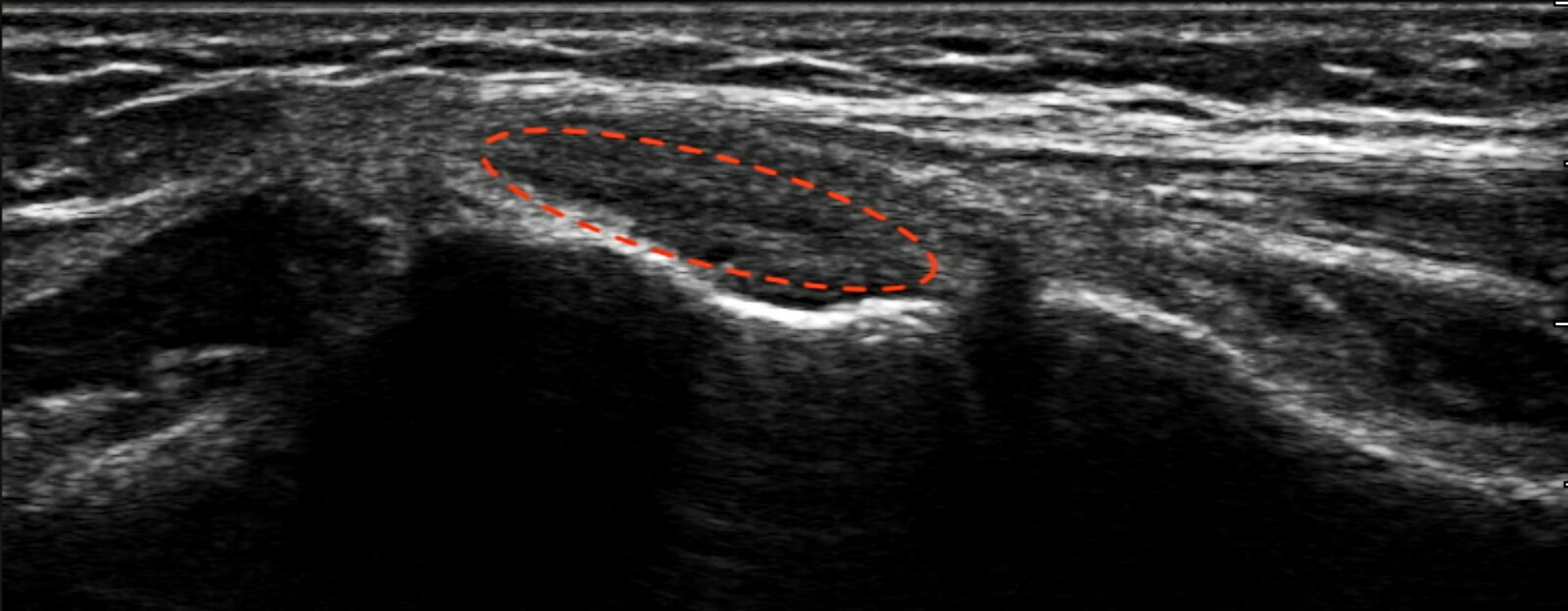 ultrasound image of torn meniscus