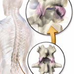 lumbar facet joint
