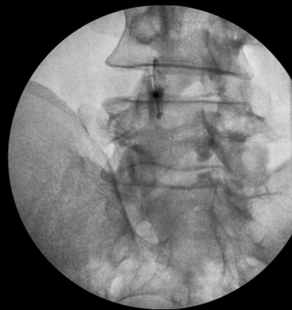 fluroscopy-guided needle entry