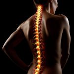 PRP epidural injection for herniated disc showing sciatic nerve compression at L5-S1